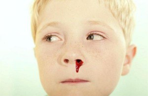 651571-o-sangramento-nasal-e-mais-comum-em-criancas