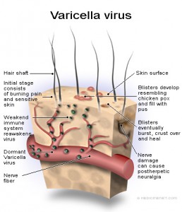 varicella_virus-shingles1