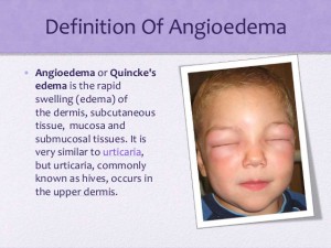 angioedema-4-638