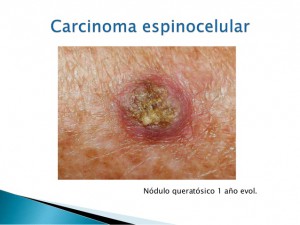 carcinoma-basocelular-y-espinocelular-36-638
