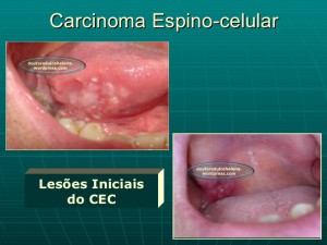 carcinoma-epidermide-5-728