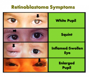 retinoblastoma-symptoms