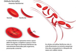 anemia-falciforme_web