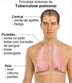 sintomas-da-tuberculose