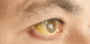 ictericia-olhos-amarelos-1484592479925_615x300