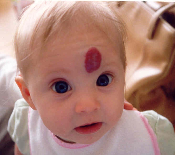 Resultado de imagem para hemangioma em bebe