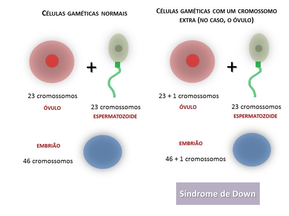 Cromossomo Da Sindrome De Down E Cromossomo Normal