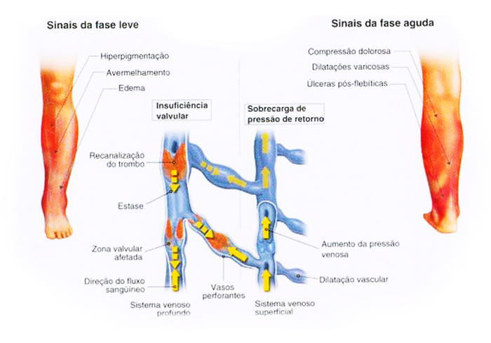 Trombose Venosa Profunda | Fernando Bragança - Pediatria E Homeopatia