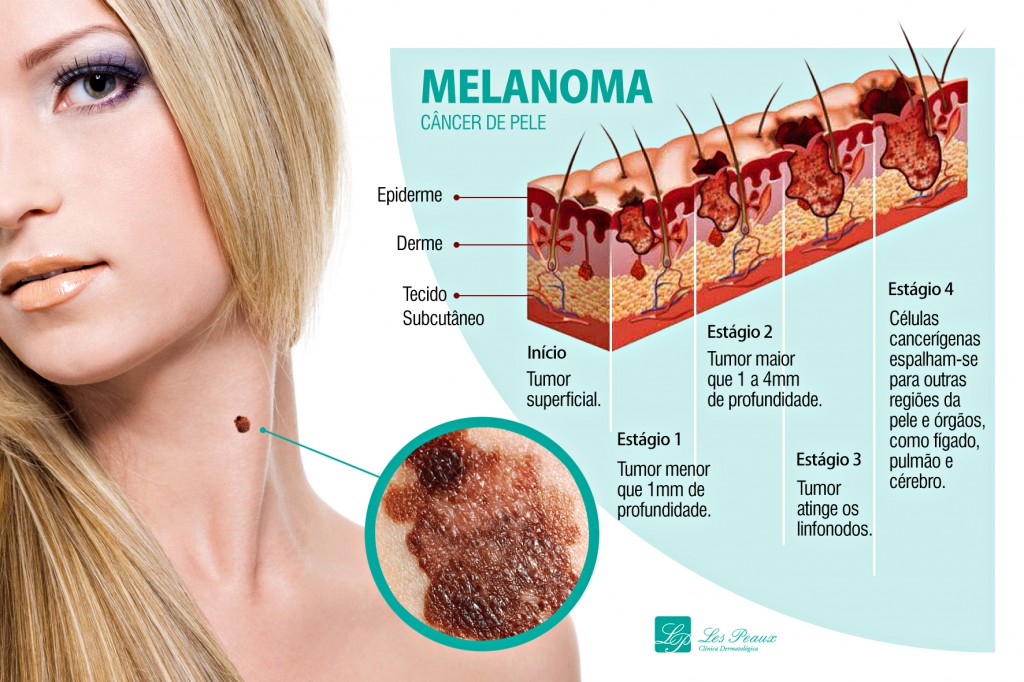 Câncer de pele principais tipos e sinais Fernando Bragança Pediatria e Homeopatia