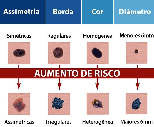 Câncer De Pele Principais Tipos E Sinais Fernando Bragança Pediatria E Homeopatia 